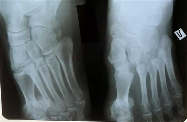 вывих в суставе Лисфранка рентген