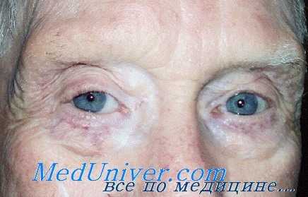 предрак века глаза