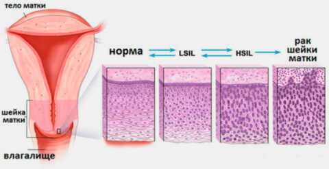 Дисплазия шейки матки