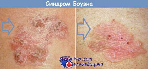 Болезнь Боуэна