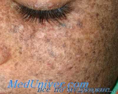 Пигментная ксеродерма