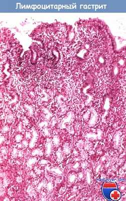 Лимфоцитарный гастрит