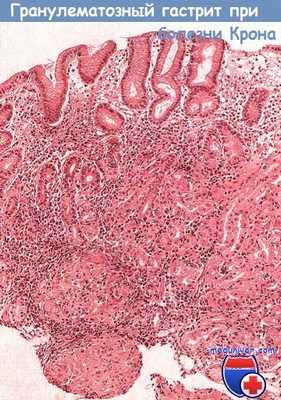 Гранулематозный гастрит