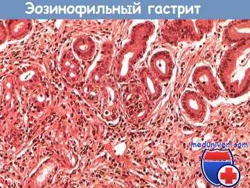 Эозинофильный гастрит