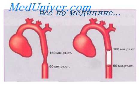 гемодинамика при коарктации аорты