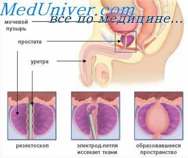 гипотермия при аденомэктомии