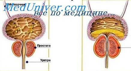 чреспузырная аденомэктомия