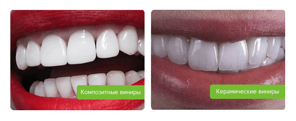 композитные и керамические виниры