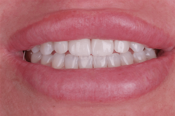 keramicheskie-ili-kompositnye-viniry