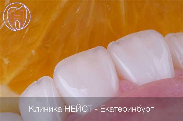 krasivye-keramicheskie-viniry-12