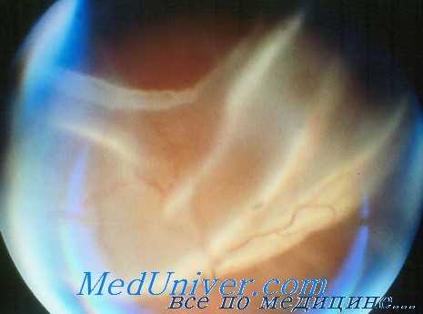 пломбирование при отслойке сетчатки