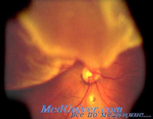 хирургия отслойки сетчатки