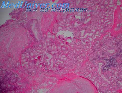 эпителий при астме