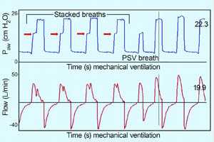Методика отлучения от ИВЛ