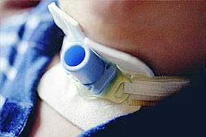 Осложнения ИВЛ