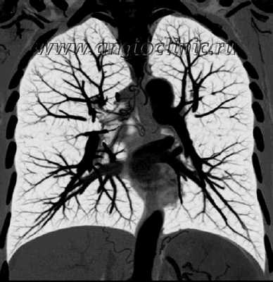 Компьютерная ангиопульмонография