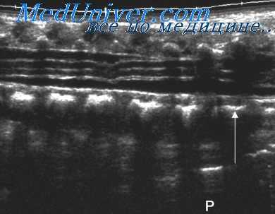 узи позвоночника плода