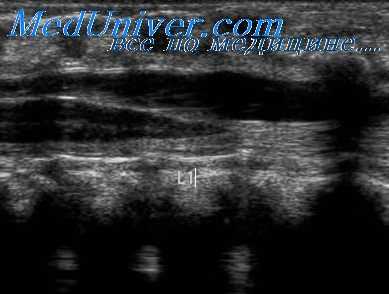 скелетные дисплазии плода