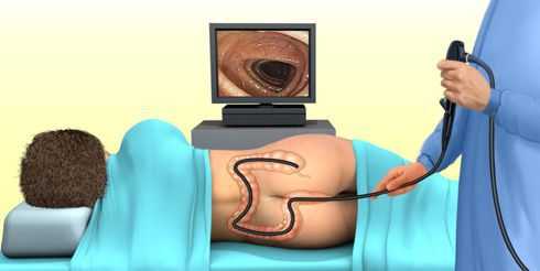 Колоноскопия (фиброколоноскопия, ФКС)