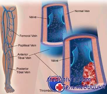 профилактика тромбоза