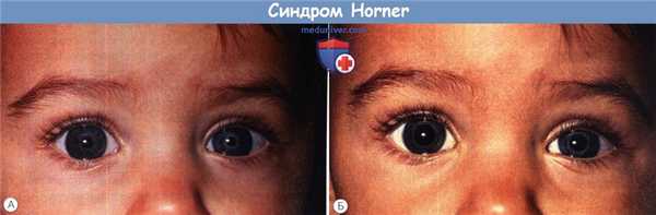 Синдром Horner (Горнера)