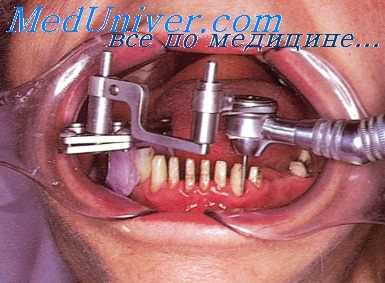 пласмассовые коронки