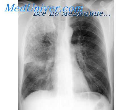 воспаление легких