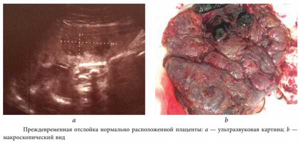 Отслойка плаценты
