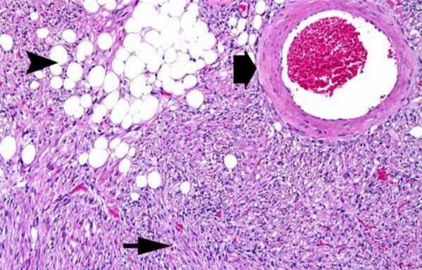 Гистологический снимок ангиомиолипомы
