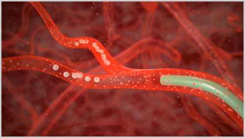 Эмболизацию почечной артерии