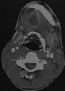 Снимки МРТ и КТ. Абсцесс полости рта