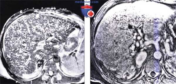 КТ, МРТ, УЗИ при врожденном фиброзе печени