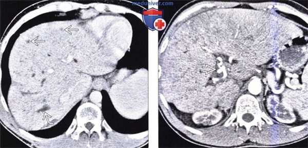КТ, МРТ, УЗИ при врожденном фиброзе печени