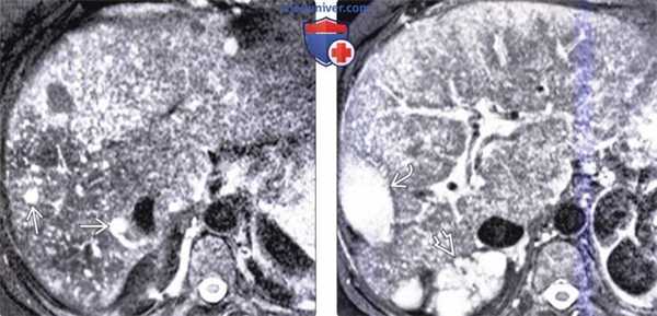 КТ, МРТ, УЗИ при врожденном фиброзе печени