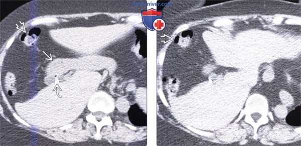 Лучевая диагностика врожденного отсутствия сегментов печени