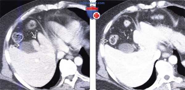 Лучевая диагностика врожденного отсутствия сегментов печени