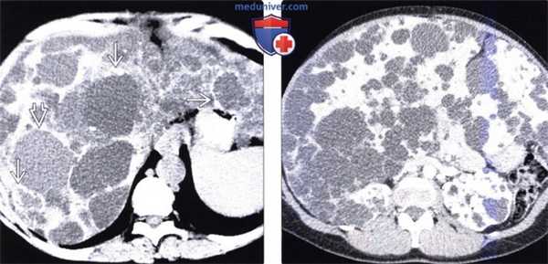 КТ, МРТ, УЗИ при аутосомно-доминантном поликистозе печени