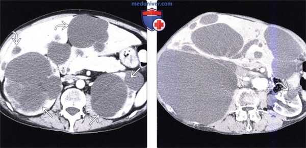 КТ, МРТ, УЗИ при аутосомно-доминантном поликистозе печени