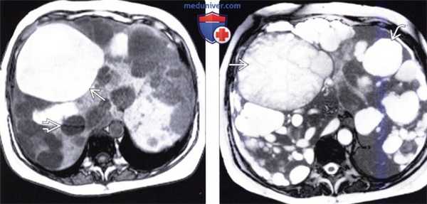 КТ, МРТ, УЗИ при аутосомно-доминантном поликистозе печени