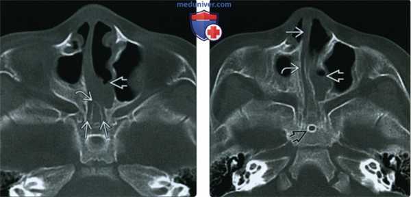 КТ при атрезии хоан