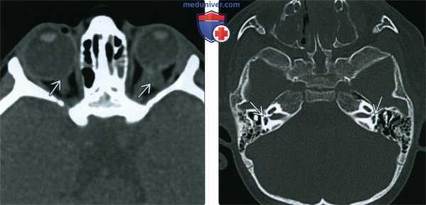 КТ при атрезии хоан
