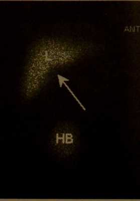 Снимки МРТ и КТ. Атрезия желчных протоков