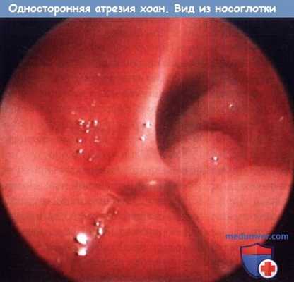 Односторонняя атрезия хоан - вид из носоглотки