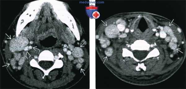 КТ, МРТ, УЗИ при гигантской гиперплазии лимфатических узлов шеи (болезни Кастлемана)