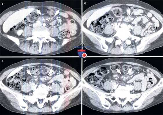 КТ при помутнении брыжейки