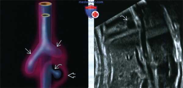Лучевые признаки бронхогенной кисты у плода