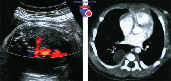 Лучевые признаки бронхогенной кисты у плода