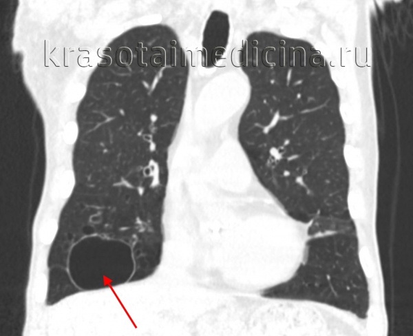 КТ ОГК. Крупное полостное образование, заполненное газом, в средней доле правого легкого.