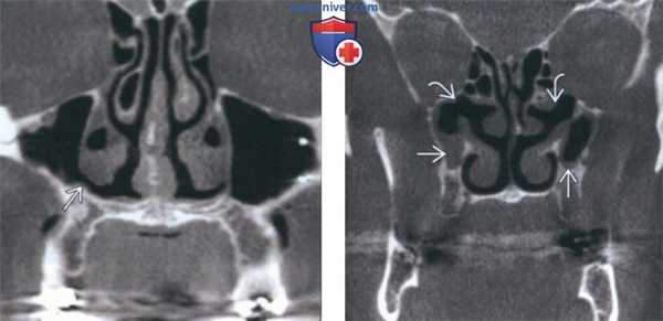 Лучевая диагностика добавочного устья верхнечелюстной пазухи