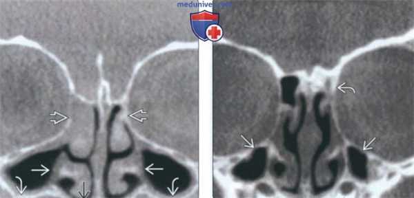 КТ при гипоплазии и аплазии околоносовой пазухи